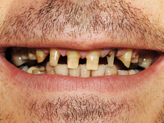 Before — Full Arch Dental Implants (All-on-6)