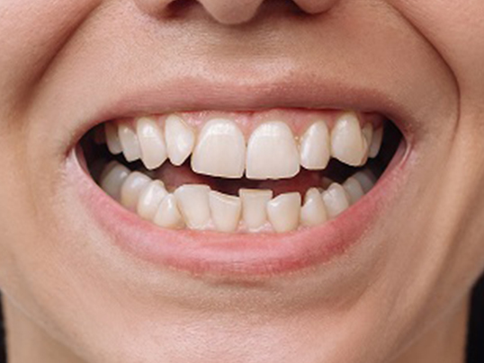 Before — Severe Crowding — Invisalign Result
