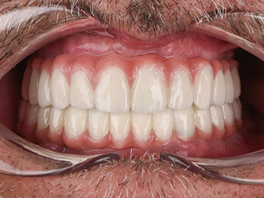 After — Discolored & Worn Teeth — Veneer Makeover