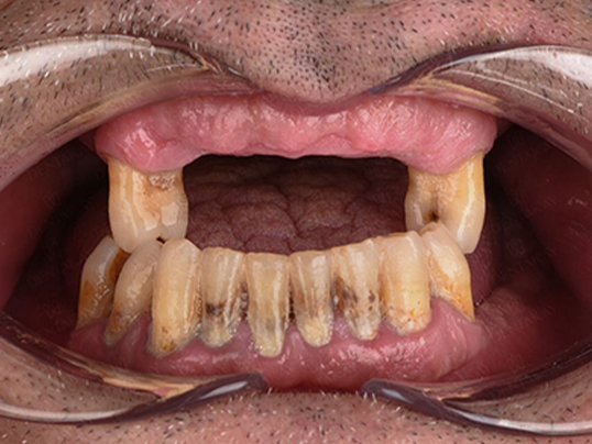 Before — Discolored & Worn Teeth — Veneer Makeover