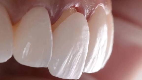 Laminate Veneers