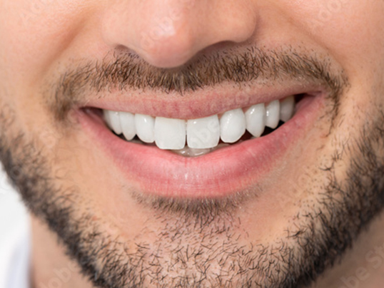 Before teeth whitening treatment at Adil Dent