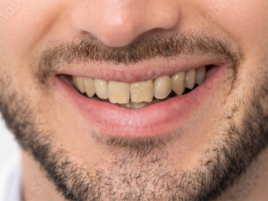 After professional teeth whitening treatment at Adil Dent