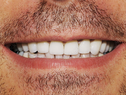 Before dental veneers treatment at Adil Dent 