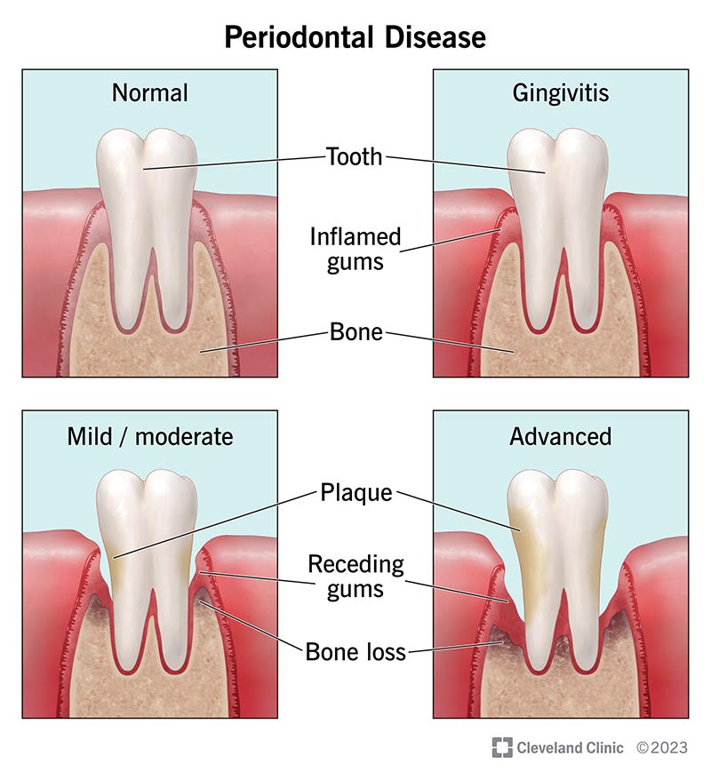 Gum Disease Illustration