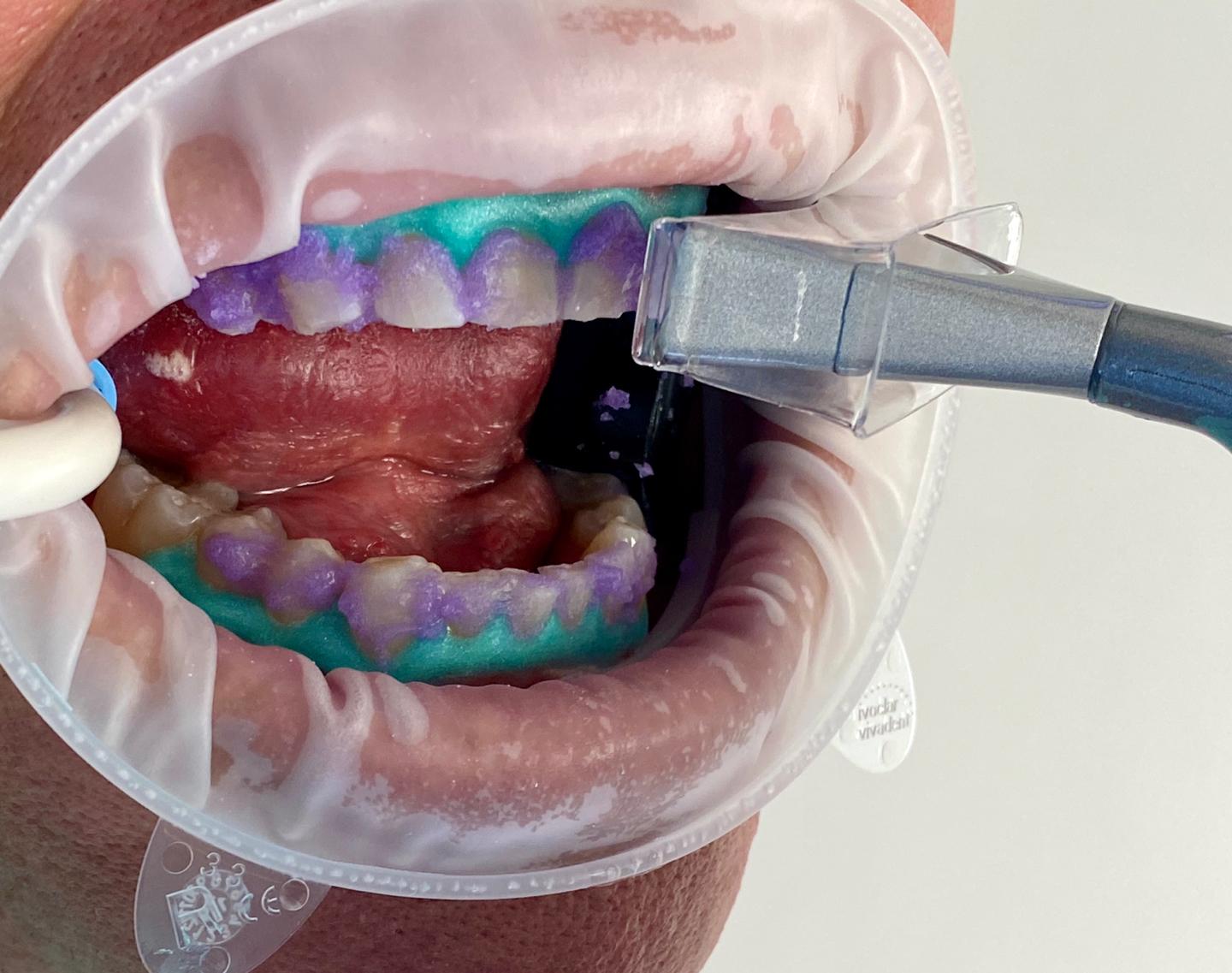 Laser Whitening Procedure